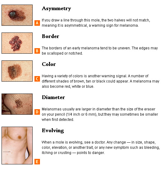 Skin Cancer