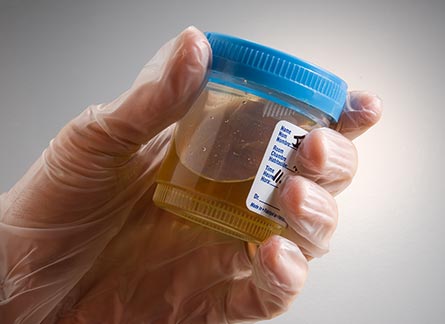 Urine test for cancer