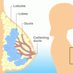 Breast Cancer Diagram