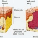 healthy skin vs skin cancer