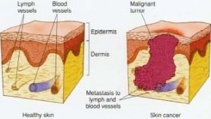 healthy skin vs skin cancer