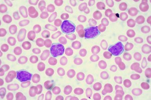 Leukemia