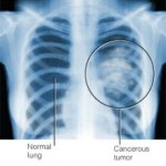 lung cancer Xray
