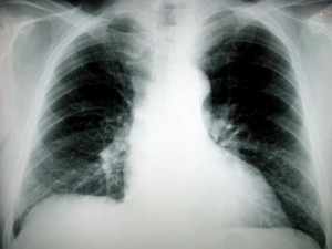 Lung Cancer