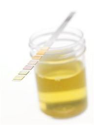 Urine test may show risk for prostate cancer