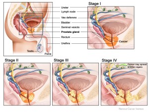 Stages of prostate cancer